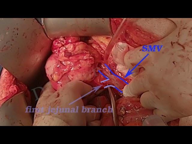 pancreatic head resection - 1   برداشتن سر لوزالمعده