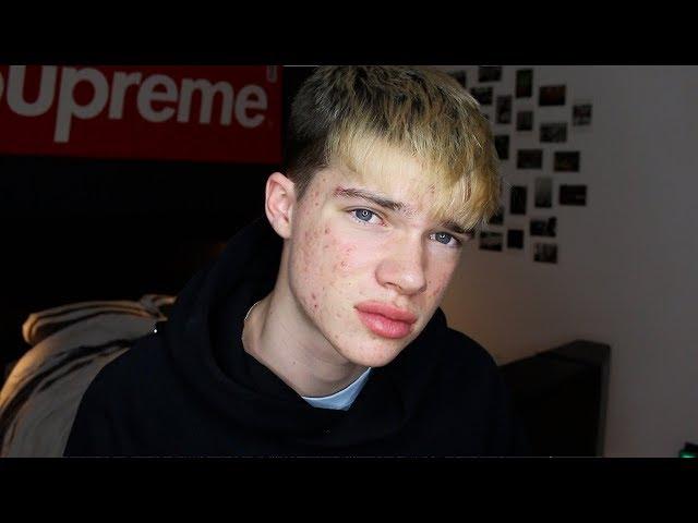the most inspirational acne video you will ever watch