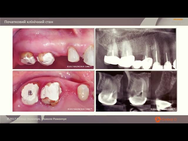 Негайна імплантація в лунки видалених зубів за одноетаповим протоколом