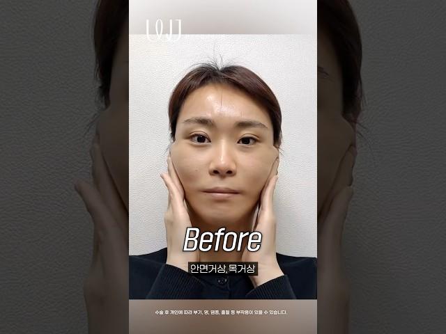 안면거상으로 늘어진 피부 고민 해결!! #shorts