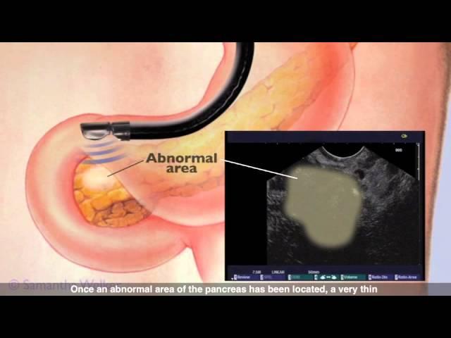 Endoscopic Ultrasound