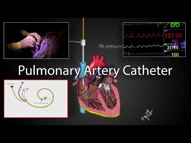 Pulmonary artery catheter (Swan-Ganz Catheter) placement and physiology