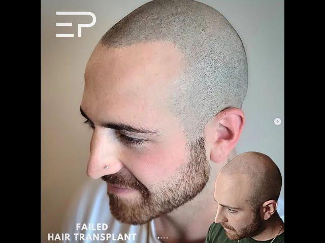 World Class Scalp Micropigmentation in Toronto Canada