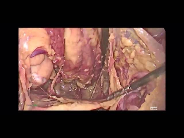 Dr. Marcello Ceccaroni, AAGL 2015 Trailer Live Interactive Cadaveric Demonstration