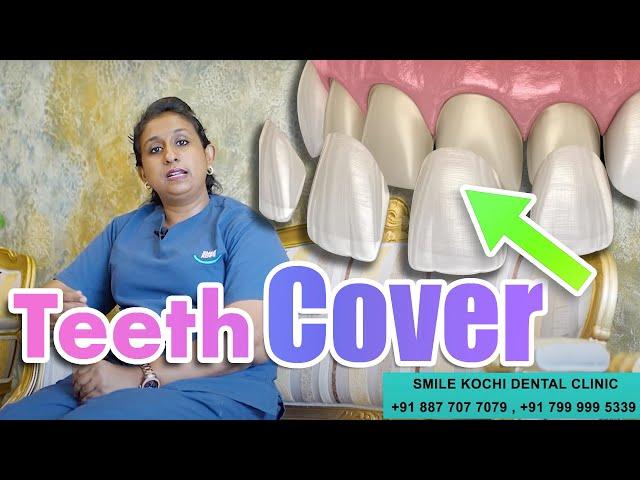 Dental Veneer (Cover) in Smile Kochi dental