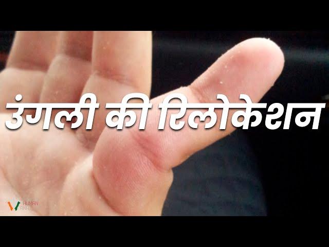 WATCH: Relocating My Patient's Finger