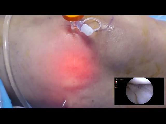 Unedited Live surgery video of Outside in Meniscal repair