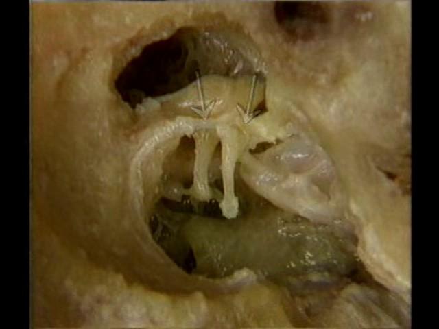 Anatomy and Physiology of ENT Organs - Auditory ossicles