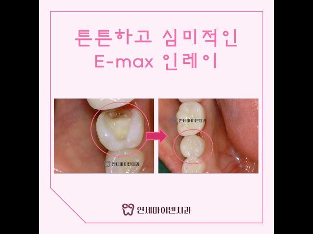 인레이 충치치료, 어떤 치료일까? 튼튼하고 심미적인 #인레이치료 #충치치료 #보존과전문의 #내치아지키기 #충치치료잘하는치과 #무통마취치과