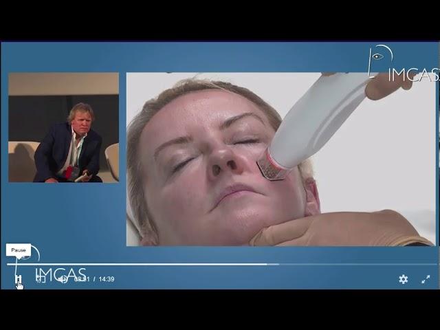 Demonstration of Onyx RF Microneedling by Dr. Patrick Treacy