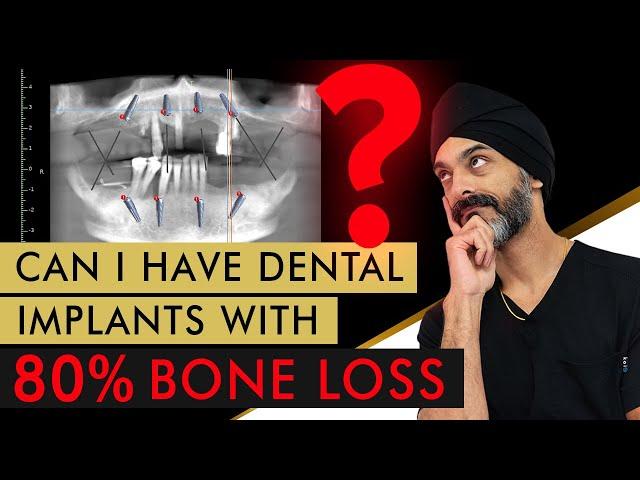 Can you have Dental Implants with 80% Bone Loss