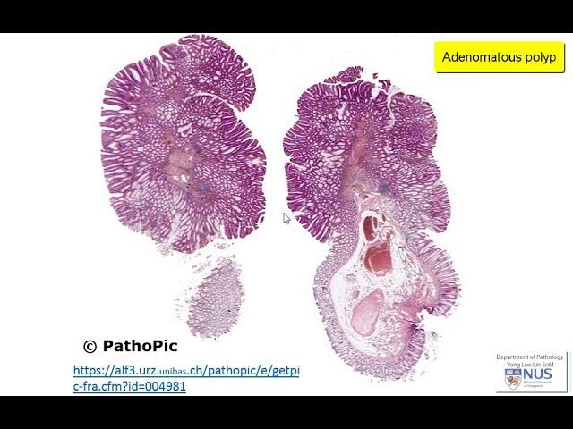 Colon: Familial Adenomatous Polyposis