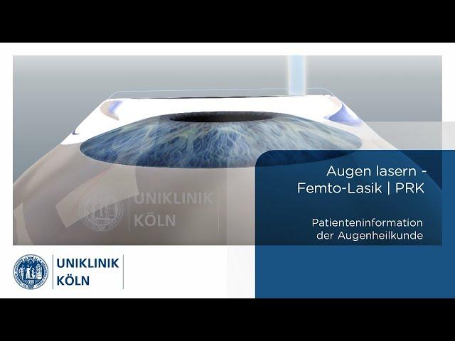 Augen lasern - Femto-Lasik | PRK | (Patienteninformation Augenklinik) | Uniklinik Köln