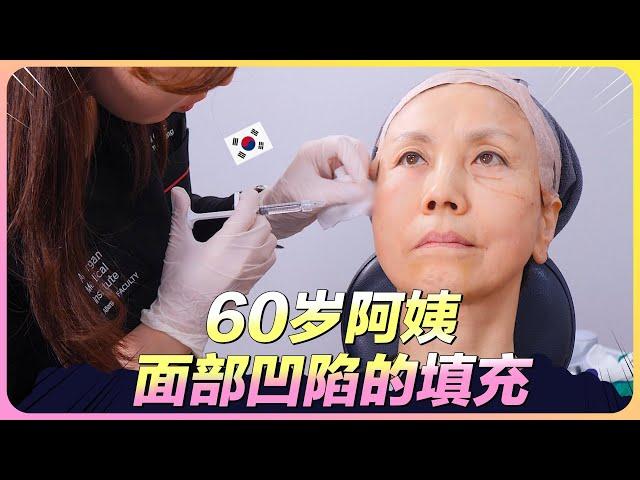 60的韩国阿姨面部凹陷怎么办？看医生如何给您变魔术！ (feat:特秀恩碧明洞店）