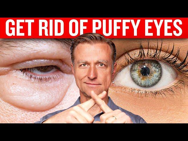 Get Rid of Puffy Eyes for Good with Dr. Berg's Proven Techniques