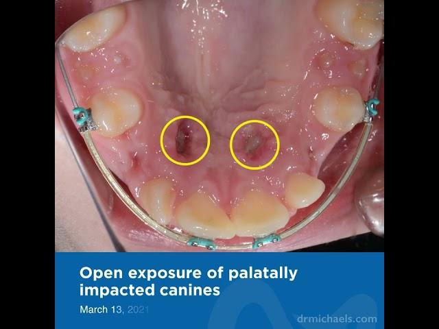 The gradual process of realigning impacted canines through orthodontic treatment by Dr Kasem Atassi