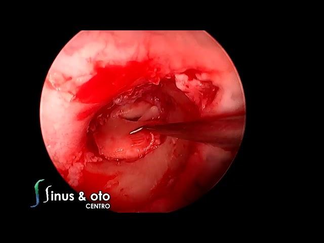 Pac-Man Tympanoplasty