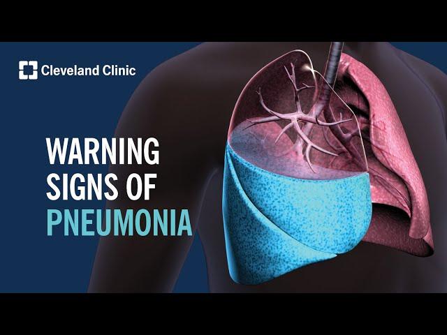 4 Warning Signs of Pneumonia