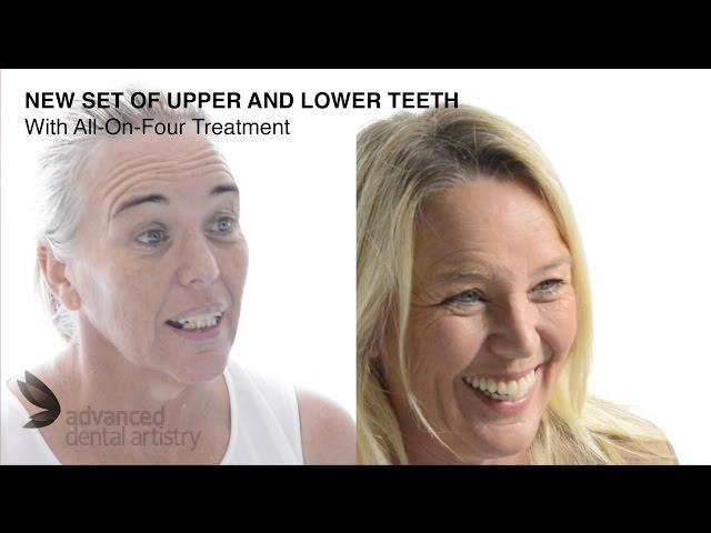 New teeth in 3 Days with All-on-four! - Kelly's treatment