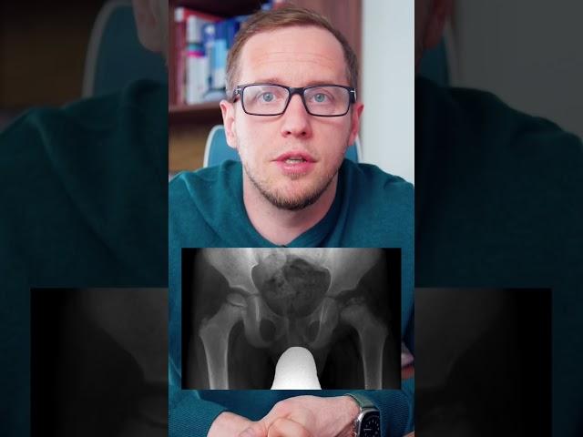 КОВИД разрушает суставы