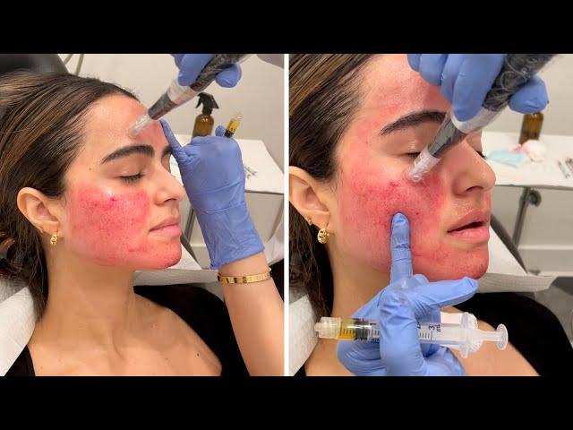 Getting the Vampire Facial  You gotta see these results!!