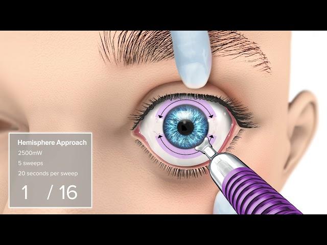 Application of MicroPulse TLT utilizing the MicroPulse P3 Probe