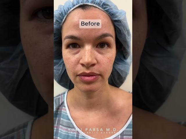 11 Weeks After Quadfecta Lift with Dr. Kami Parsa | Hooded Upper Eyelids & Lower Eye Bags Treatment