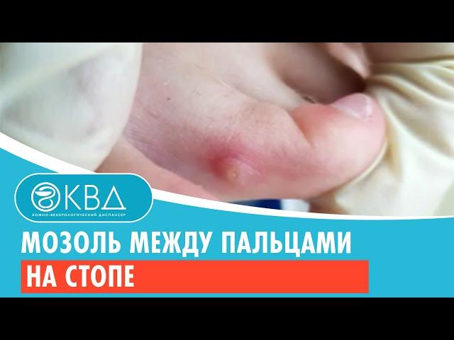  Мозоль между пальцами на стопе. Клинический случай №169