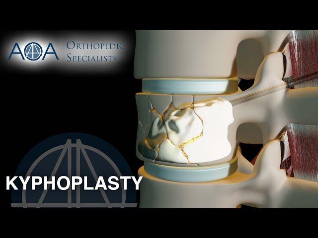 AOA Orthopedic Specialists - Kyphoplasty