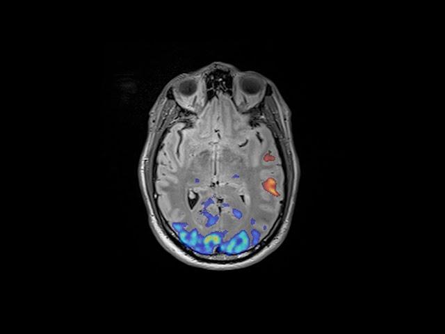 Mayo Clinic Minute - Brain mapping improves surgical outcomes