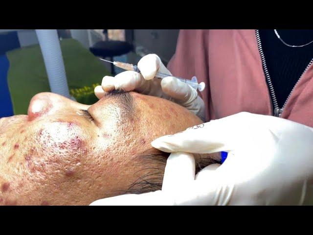 The best acne squeezing collection form Linh Mun Spa part 8