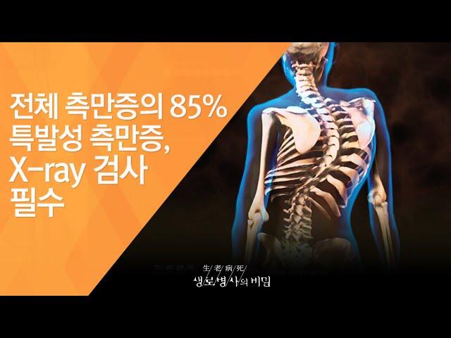 전체 측만증의 85% 특발성 측만증, X-ray 검사 필수 - (2011.4.2_367회 방송)_내 몸의 기둥, 척추