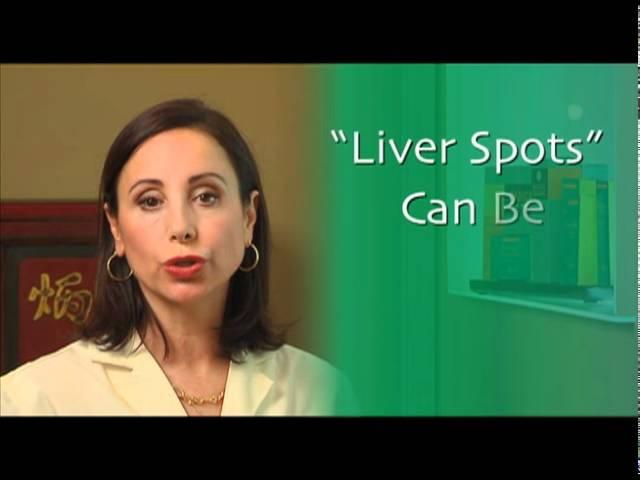 How to Treat Liver Spots