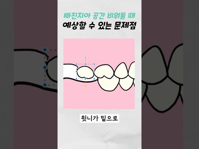 빠진 치아 공간 비워둘 때 예상할 수 있는 문제점#발치 #임플란트 #잠실치과