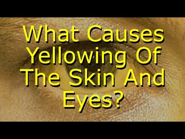 What Causes Yellowing Of The Skin And Eyes?