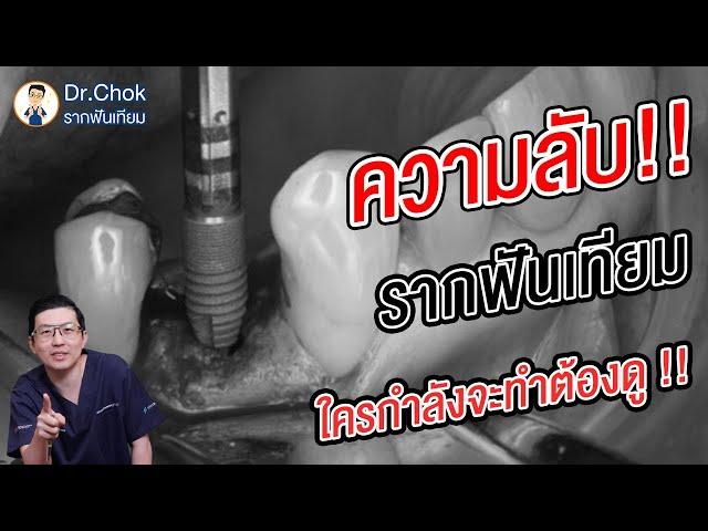 รากฟันเทียมคืออะไร ? ใครจะทำรากฟันเทียมต้องดู !!! | คลายปัญหารากฟันเทียมกับหมอโชค