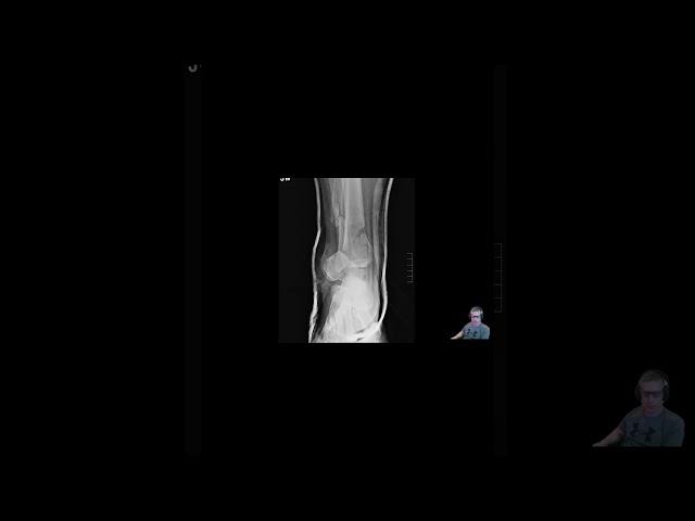 Acute Compartment Syndrome Xray #meded #trauma #orthopedicsurgeon #criticalcare