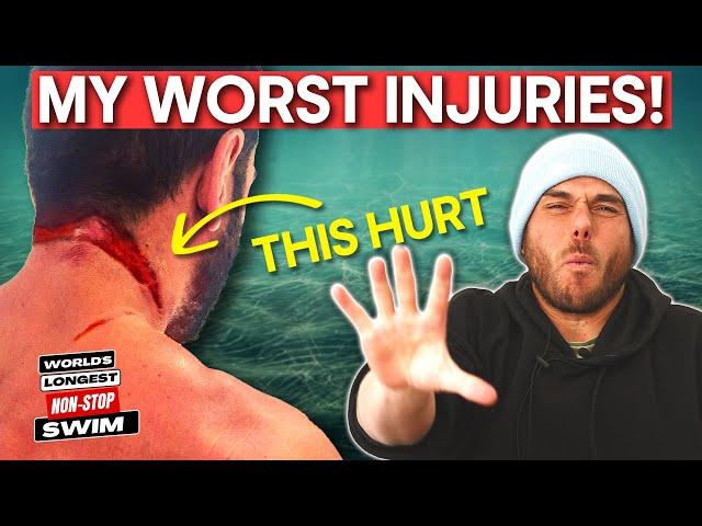 The WORST (5) Injuries: Long-Distance Swimming!