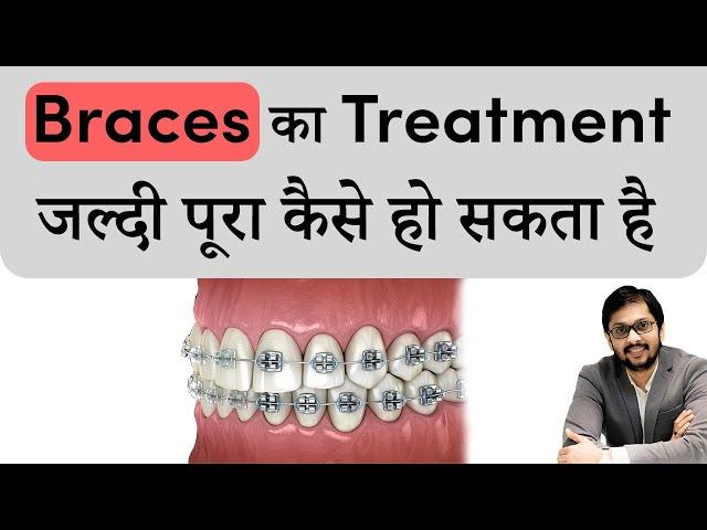 Braces का Treatment जल्दी कैसे पूरा हो सकता है | Braces treatment procedure | Seraphic dental Indore