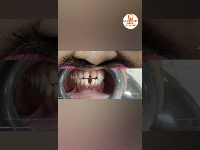 Dental Implants and Digital Smile Designing At Eledent Hospital || Best Dental Hospital || #shorts