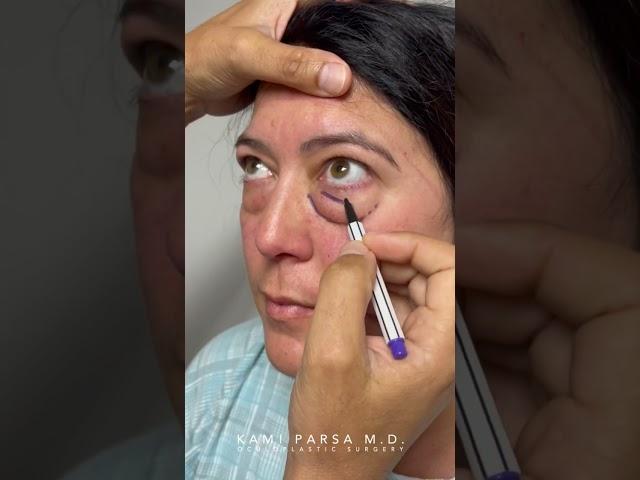 Miss, You Forgot Something | Blepharoplasty for Lower Eye Bags | Dr. Kami Parsa