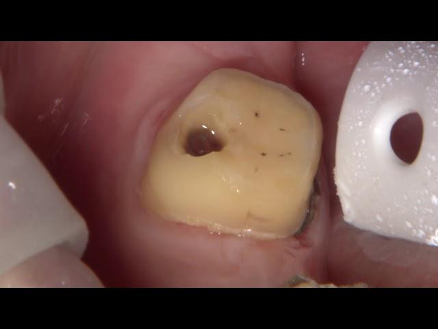 Case of the Week: Dealing with Path of Insertion Troubles