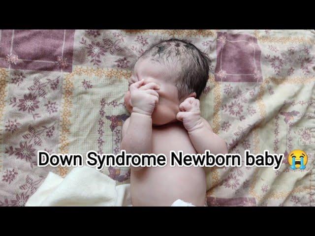 Cutest Down Syndrome newborn baby getting dressed up just after birth #cute #love #usa