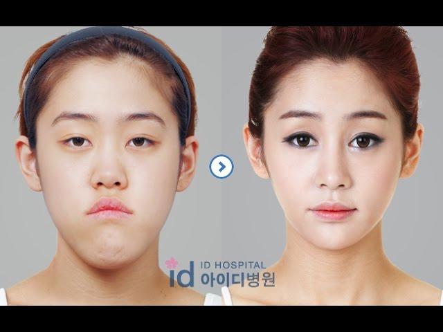 [id hospital review] before and after plastic surgery in korea(v-line, eye, nose and fat graft)