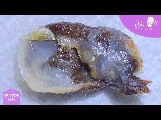 1,160 - Fully Blocked & Sealed Ear Wax Removal