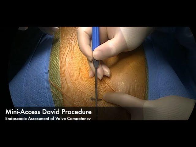 Deep Dive Into Aortic Surgery Mini-Access David Procedure—Endoscopic Assessment of Valve Competency