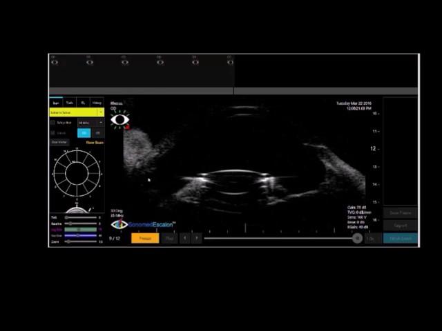 UBM of Axial Shift AD-IOL with Zonular Capture Haptics