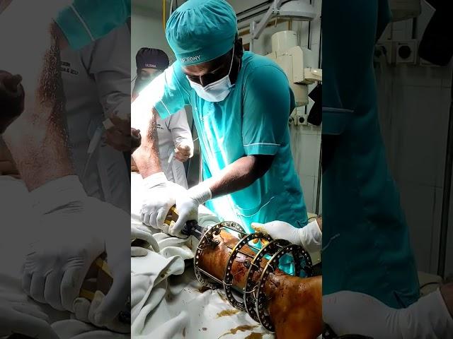 #ilizarov external fixator removal #orthopaedics #surgery #shorts #viralshort #drrony