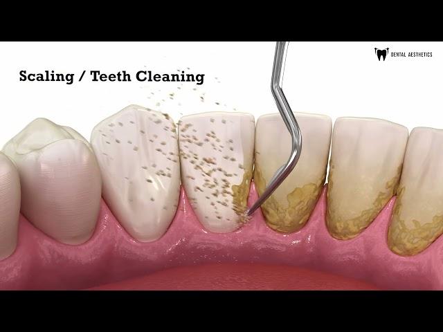 Scaling | Teeth Cleaning | Teeth Scaling | Scaling And Polishing | Dental Aesthetics