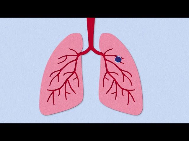 Fibrosis Explained